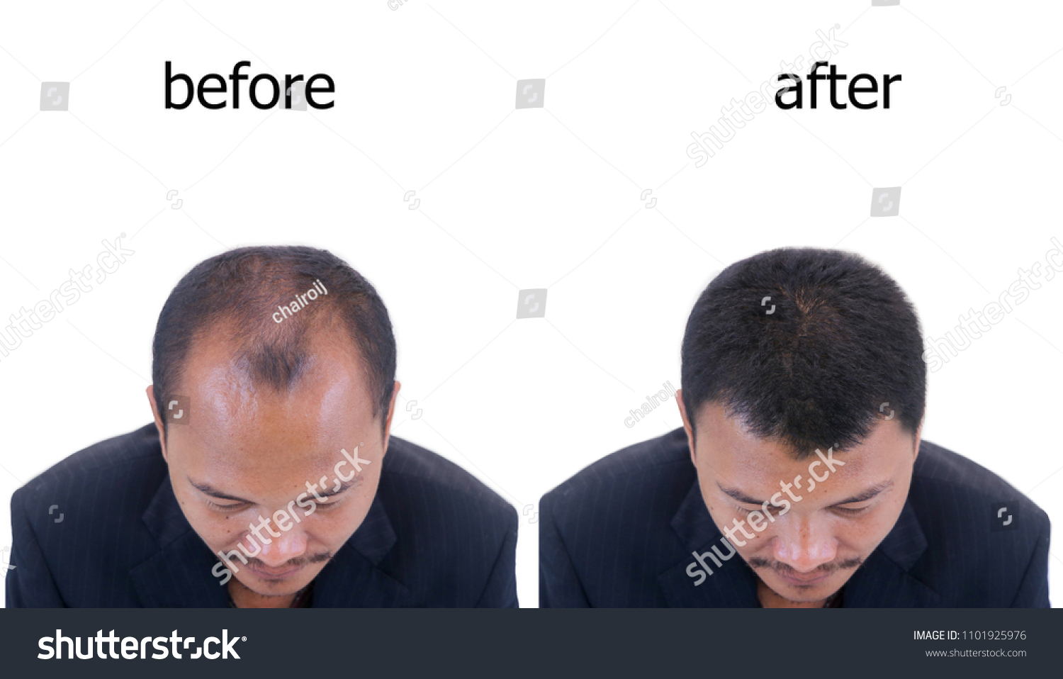 Hair Transplant Image 2