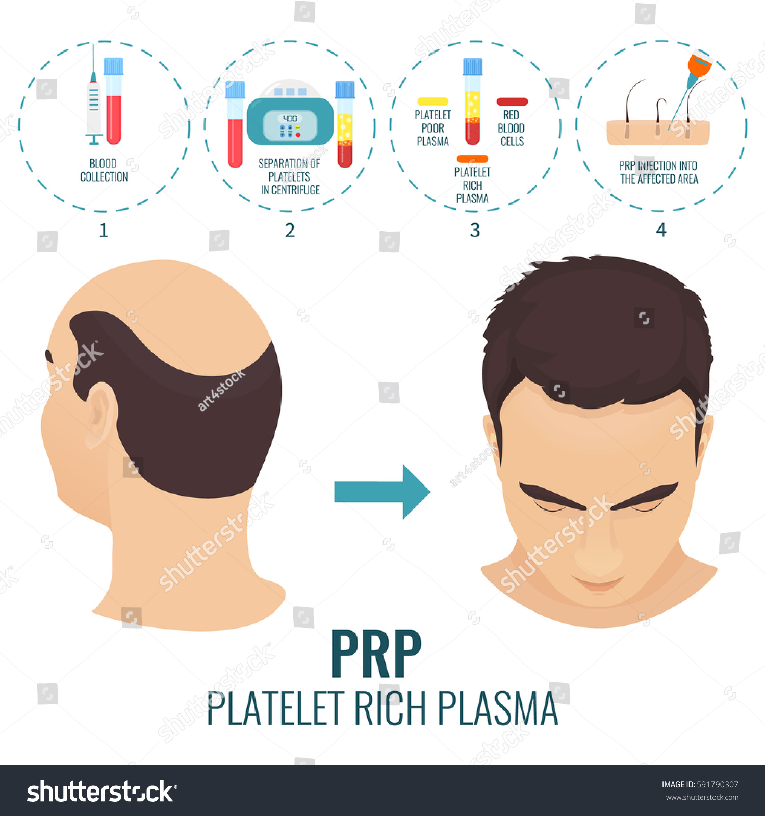 Hair Transplant Image 3
