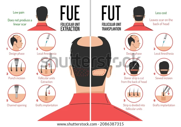 Hair Transplant Image 4